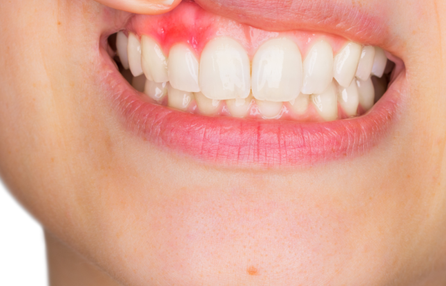 geïrriteerd tandvlees